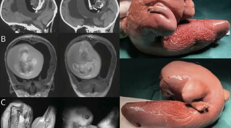 Fetus Removed from One-Year-Old Girl's Brain